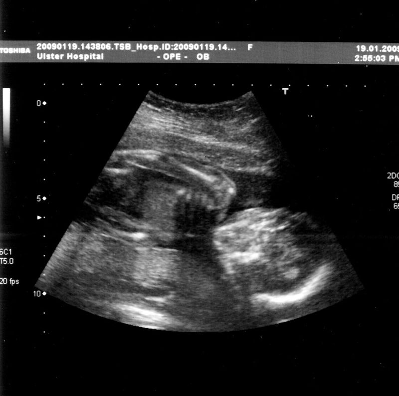 Baby_scan_20_weeks